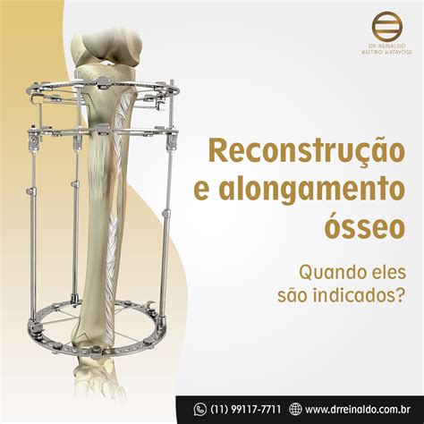 Reconstrução e Alongamento Ósseo 